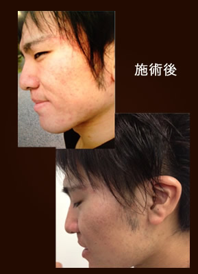 INUPフェイシャル 施術後
