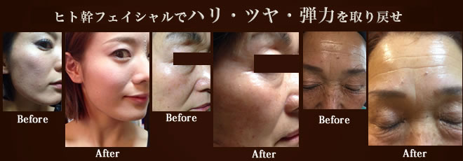 ヒト幹フェイシャル　ビフォーアフター
